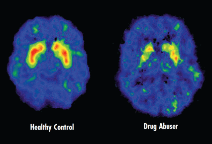 Two brain scans. The first scan shows a healthy brain. The second scan shows decreased dopamine transporters in the brain of 